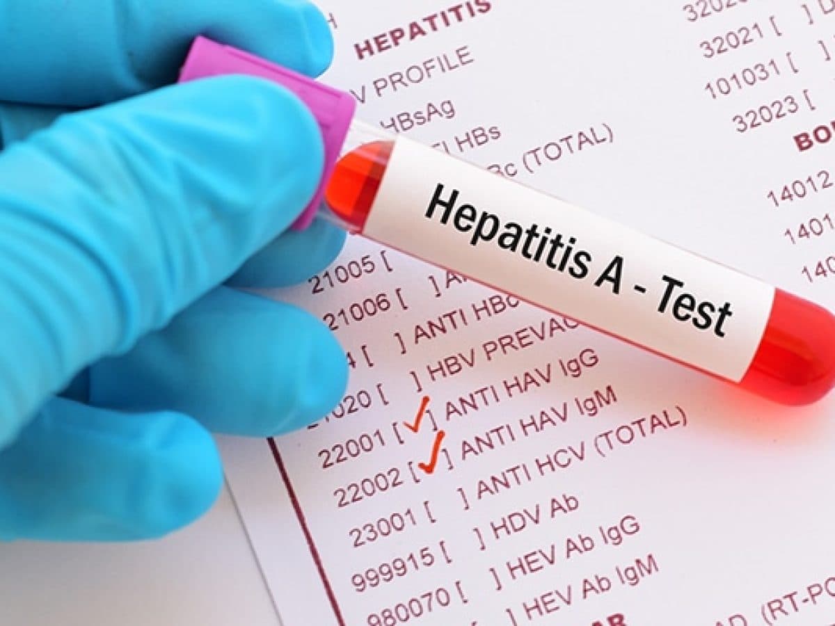 Hepatitis A: la confirmación de 34 nuevos casos sitúa a la Argentina en zona de alerta